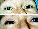 Eyelid Pigmentation Image