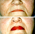 Lip Enhancement and Reconstruction Image