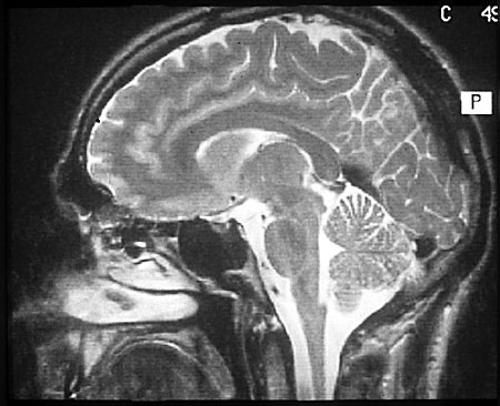 MRI image