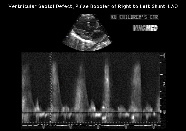 Doppler study of VSD