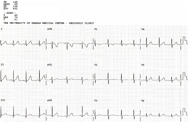 Normal EKG