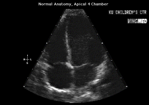 Normal Echocardiogram