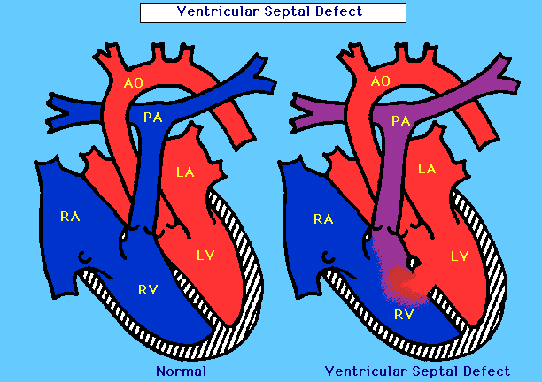 Diagram of VSD