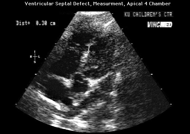 Echo of VSD