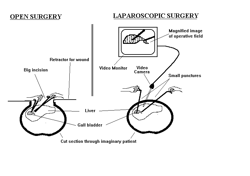 Open and Keyhole Surgery: differences