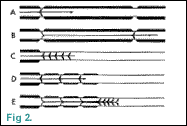 Conduction Restoration