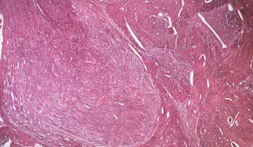 Myometrium with confluent nests of tumor cells