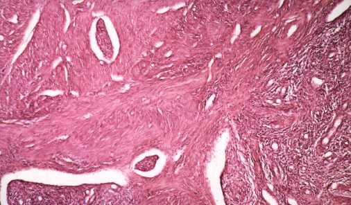 Tumor cells in lymph vessels