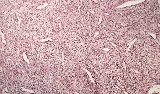 Highly vacular tumor tissue with storiform growth pattern