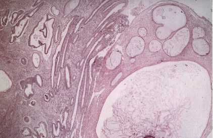 Simple Lyperplasia of endometrium and cystic polyp