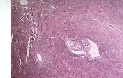 Endometrial glands in myometrium, surrounded by endometrial stroma (adenomyosis)