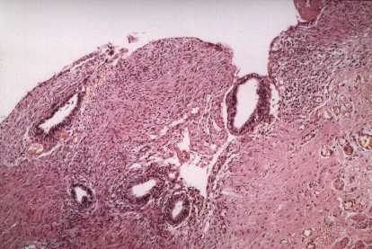 Endometriosis in retrocervical tissue