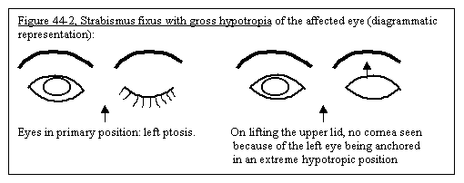 Strabismus fixusm with gross hypotropia