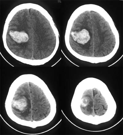 hepatoma_ct.jpg (31034 bytes)