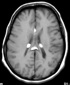 lipoma_corp_mri.jpg (19143 bytes)