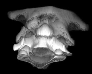 3d odontoid.jpg (11684 bytes)