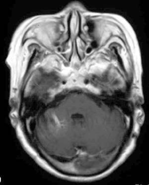 vm mri.jpg (19355 bytes)