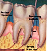 Advanced Periodontitis