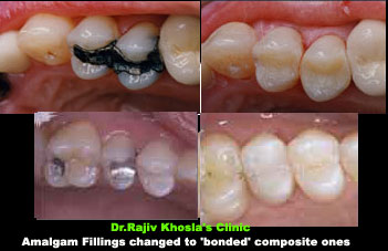 Amalgam fillings changed to composite