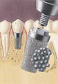 Endopore Implants