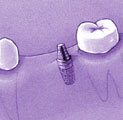 Endopore implant in bone