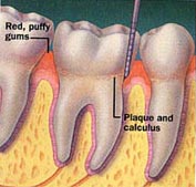 Gingivitis