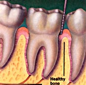 Healthy Gums