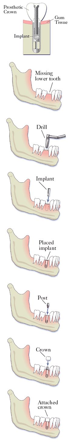 Dental Implant Procedure