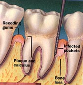 Periodontitis