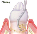 Root Planing