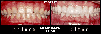 Before & After pics - Veneers