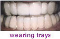 TRAYS PLACED IN MOUTH