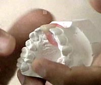 The prototype ultrasound device can be mounted on braces or a plastic removable crown.