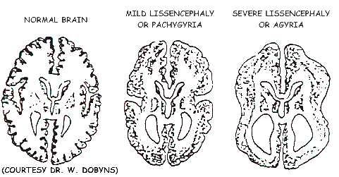 Drawing of Normal Brain, Pachygyria & Agyria