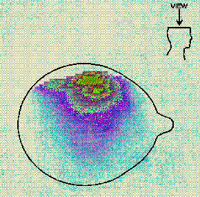 Cross section of Thermal Distribution of RF Absorption in the Head - 43695 Bytes