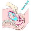 Picture of an amniocentesis procedure